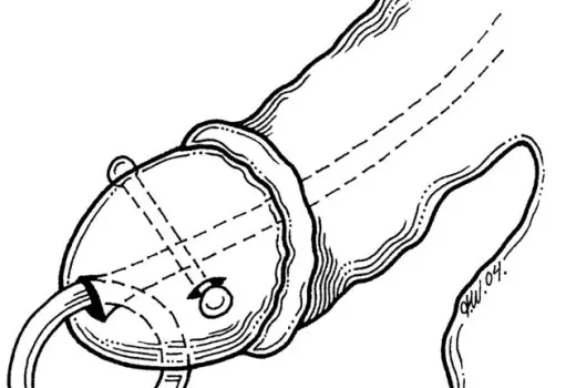 The Dangers of Penis Piercing